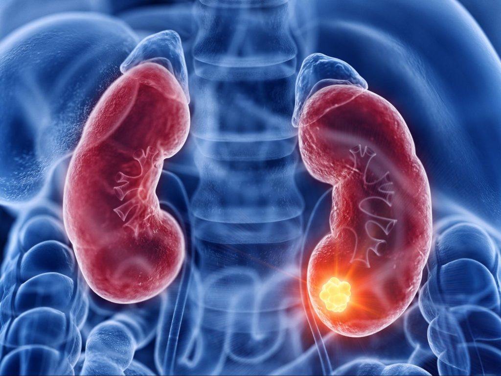 a graphic highlighting the kidneys